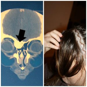 The author's brain tumor led to a period of post-traumatic growth